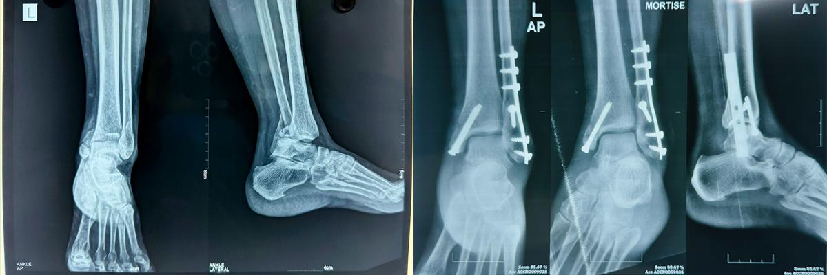 ORIF Ankle fixation1