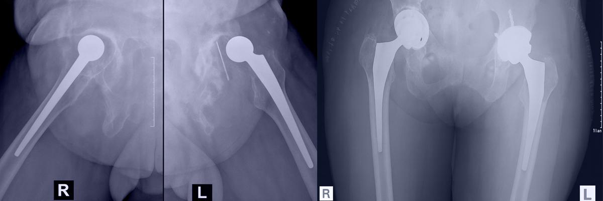 Revision Hip Replacement..