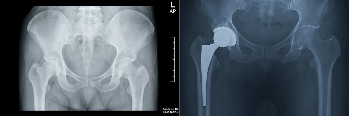 Total Hip Replacement_Edited